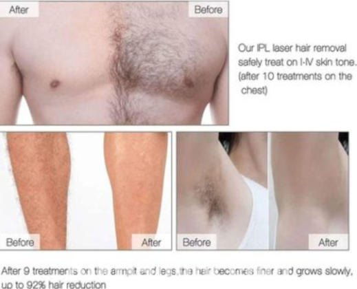 Permanent hair removal IPL laser. Kemei km6812